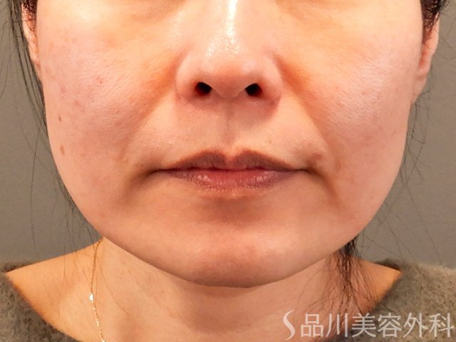症例NO.69798のBEFORE写真
