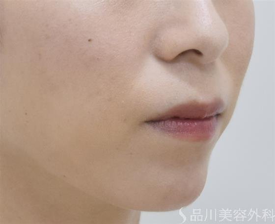 症例NO.42879のAFTER写真