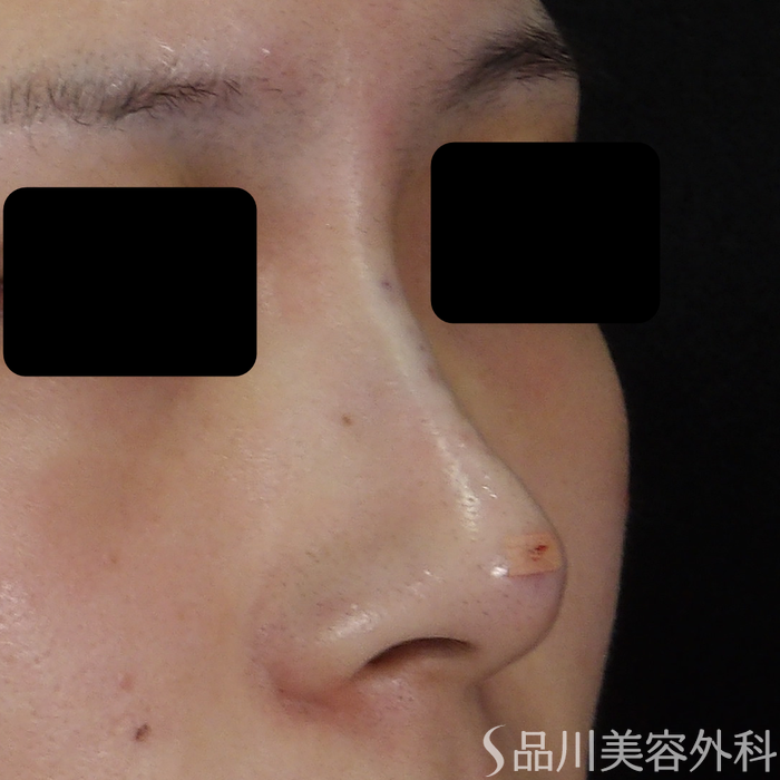 症例NO.70926のAFTER写真