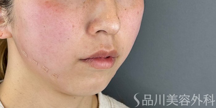 症例NO.69461のAFTER写真
