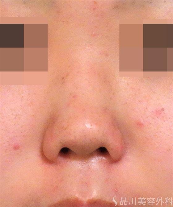 症例NO.39253のBEFORE写真