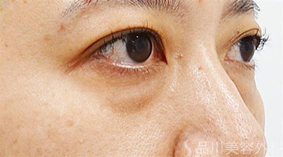 症例NO.48951のBEFORE写真