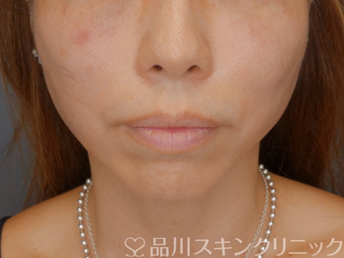 症例NO.70987のAFTER写真