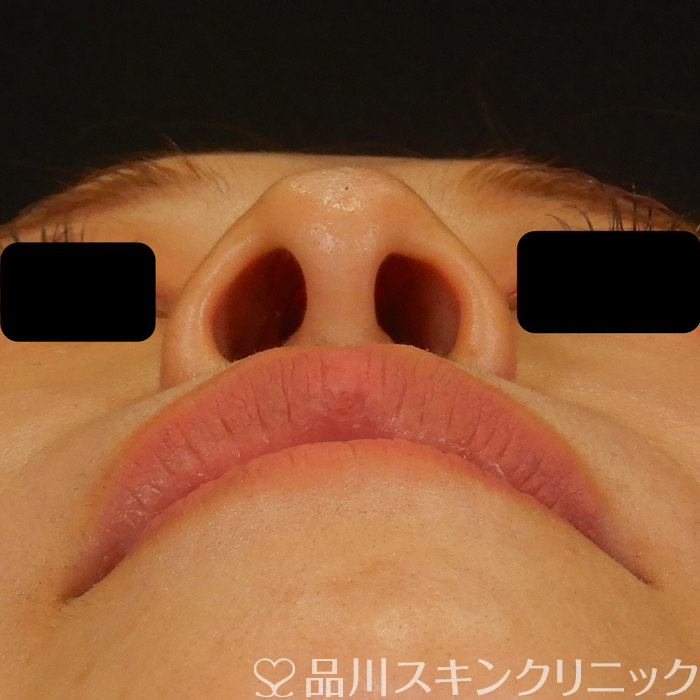 症例NO.69583のAFTER写真