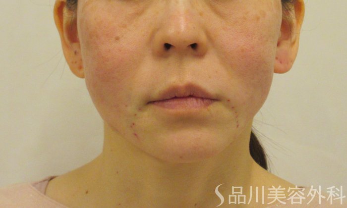 症例NO.73221のAFTER写真