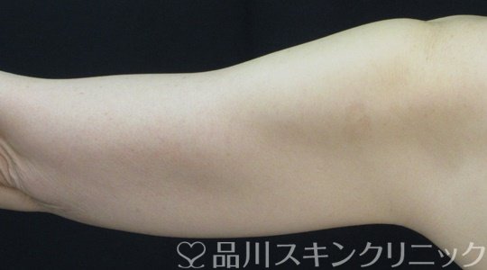 症例NO.71721のBEFORE写真