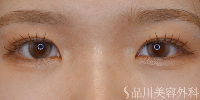 症例NO.70026のAFTER写真