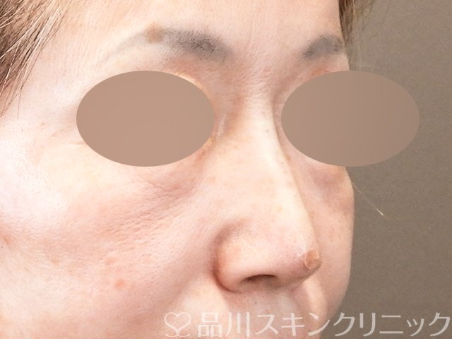 症例NO.67107のAFTER写真