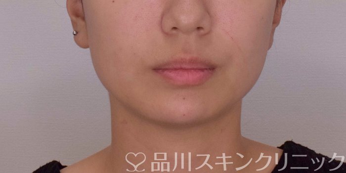 症例NO.67764のAFTER写真