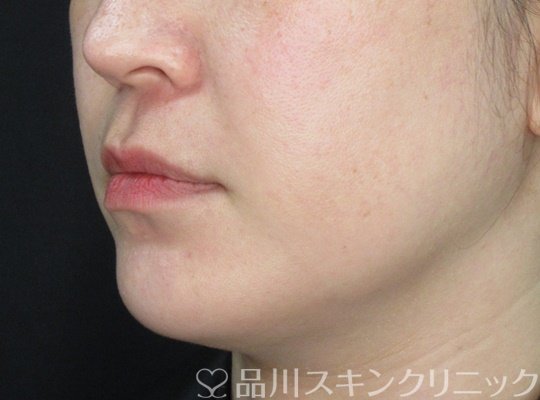 症例NO.71390のAFTER写真