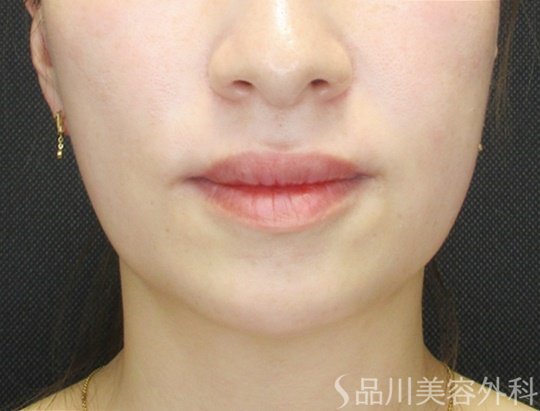 症例NO.70355のBEFORE写真