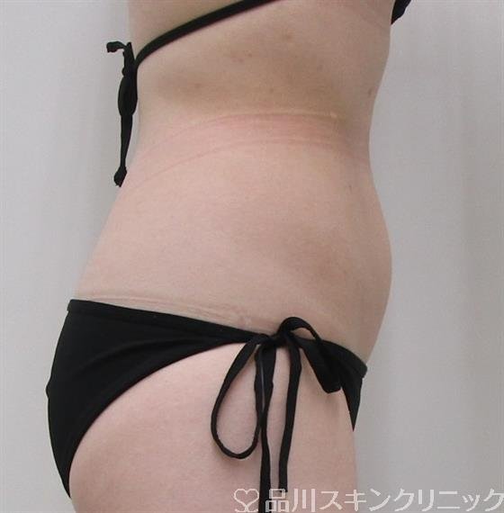 症例NO.42237のBEFORE写真