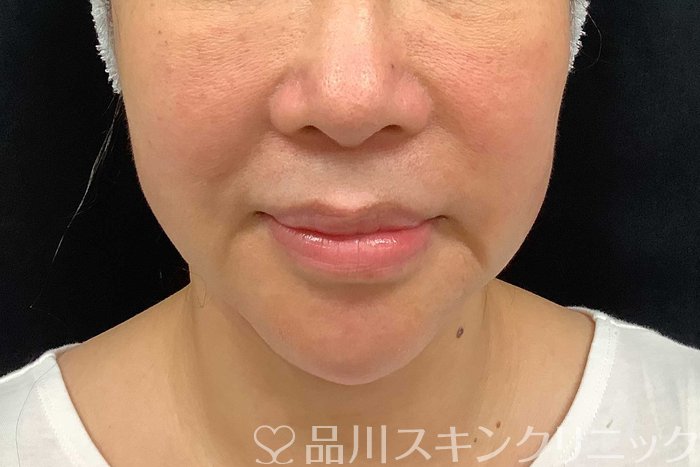 症例NO.69917のBEFORE写真