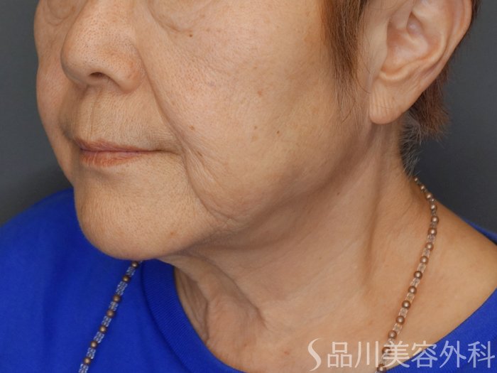 症例NO.71772のBEFORE写真