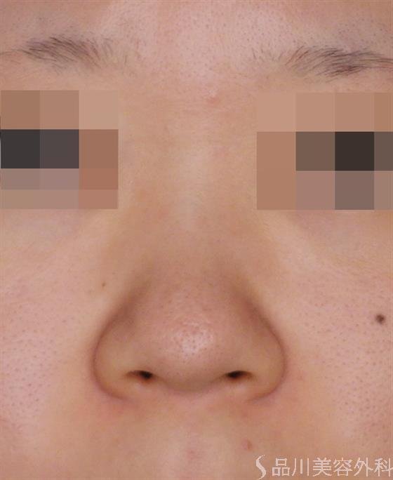 症例NO.49499のBEFORE写真