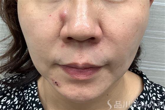 症例NO.55910のBEFORE写真