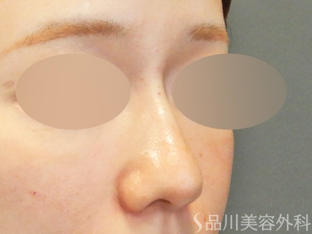 症例NO.67901のAFTER写真