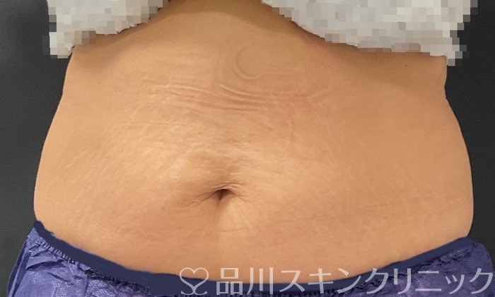症例NO.74680のAFTER写真