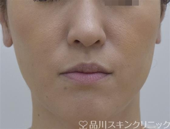 症例NO.53598のAFTER写真