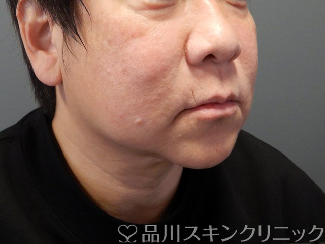 症例NO.68572のBEFORE写真