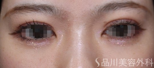 症例NO.69525のAFTER写真