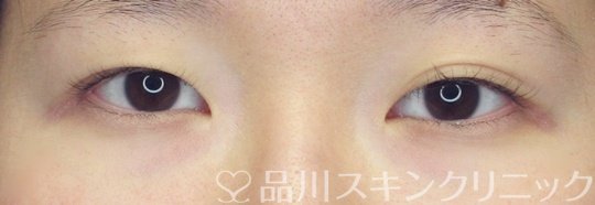 症例NO.70988のBEFORE写真