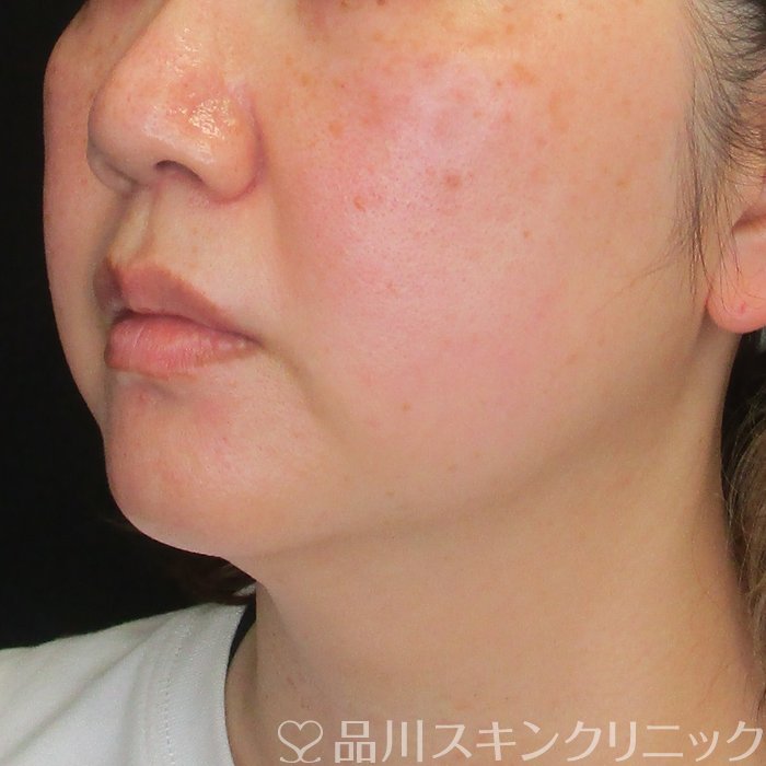 症例NO.72947のBEFORE写真