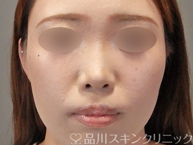 症例NO.75251のBEFORE写真