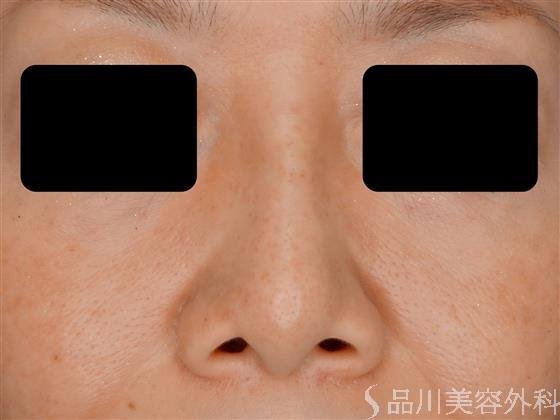 症例NO.56142のAFTER写真