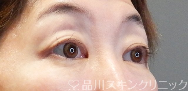 症例NO.67658のBEFORE写真
