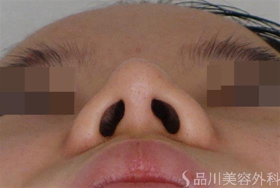症例NO.50988のAFTER写真