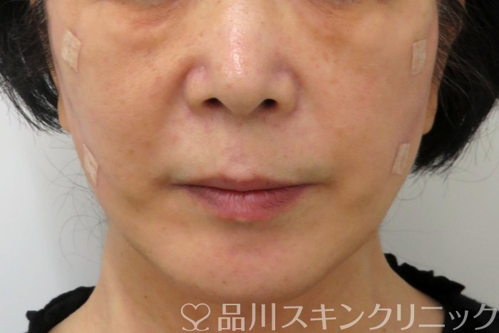 症例NO.74808のAFTER写真