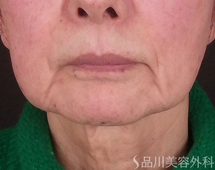 症例NO.69752のBEFORE写真