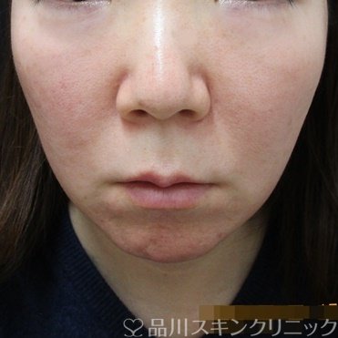 症例NO.69982のBEFORE写真