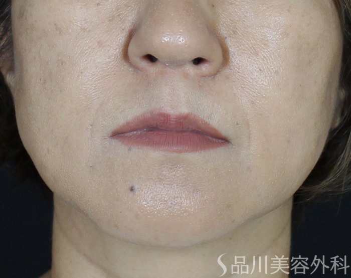 症例NO.69386のAFTER写真