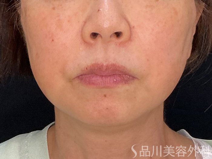 症例NO.71826のAFTER写真