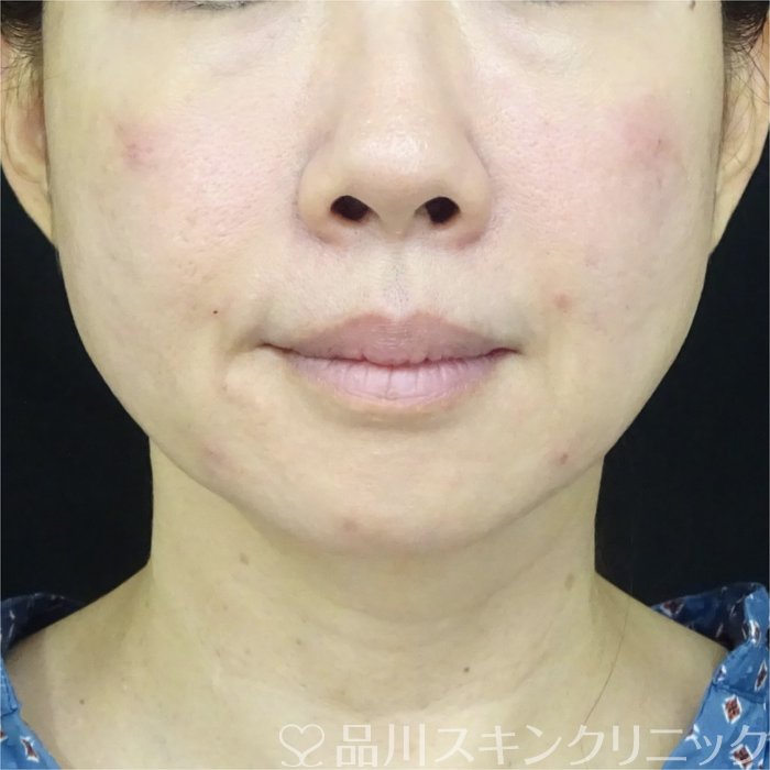 症例NO.72007のAFTER写真