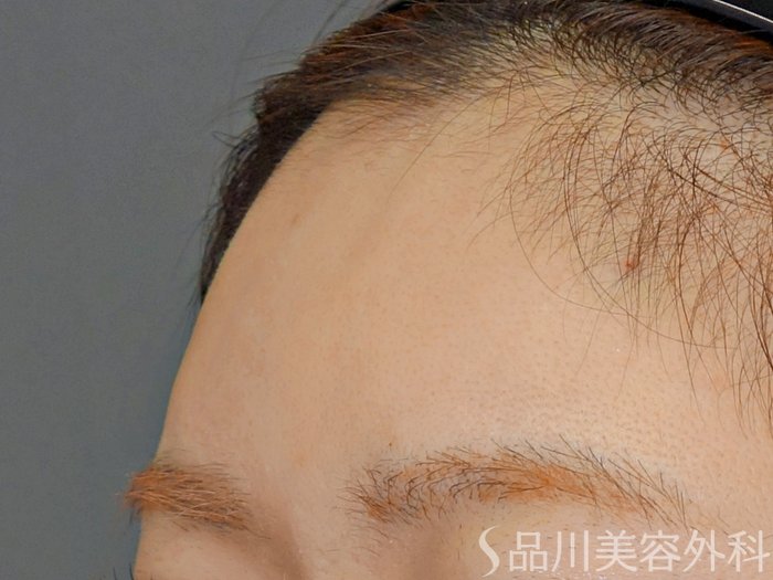 症例NO.72860のAFTER写真