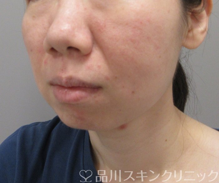 症例NO.73091のBEFORE写真