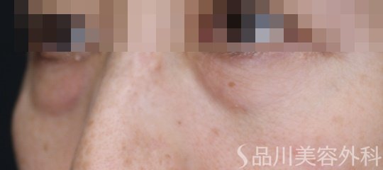 症例NO.72556のBEFORE写真