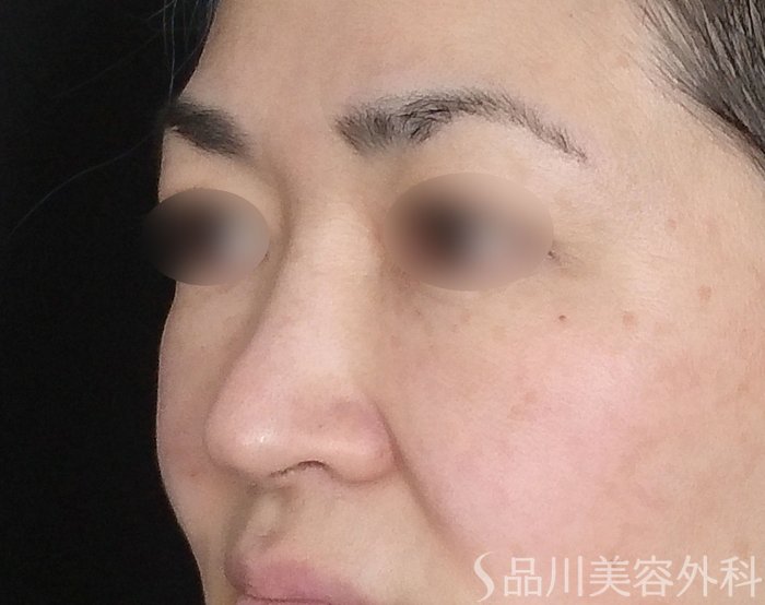 症例NO.69821のBEFORE写真