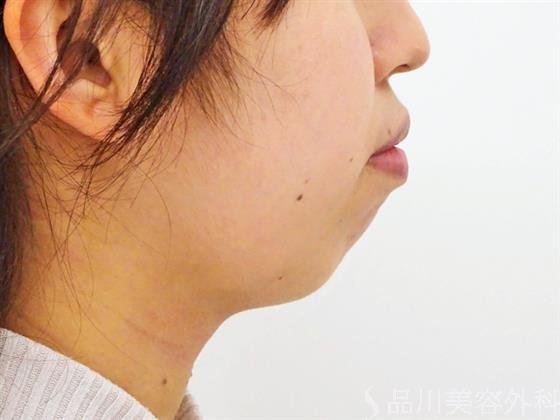 症例NO.53890のBEFORE写真