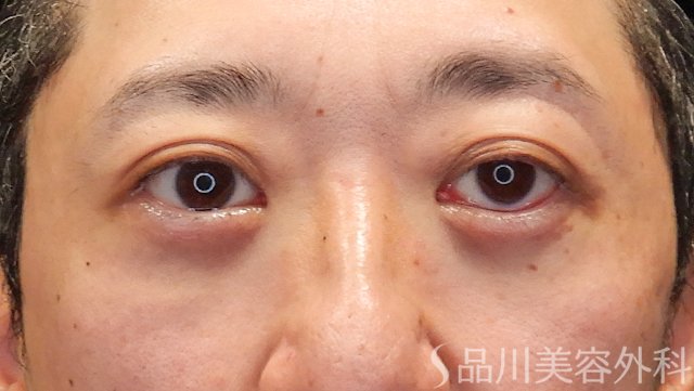 症例NO.74560のAFTER写真