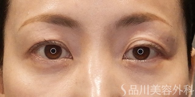 症例NO.74797のAFTER写真