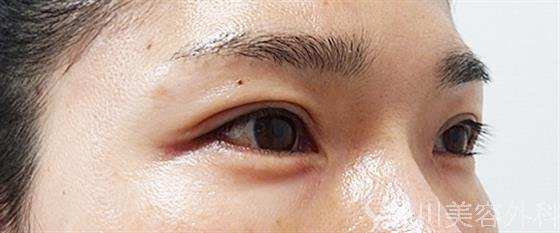 症例NO.53744のAFTER写真