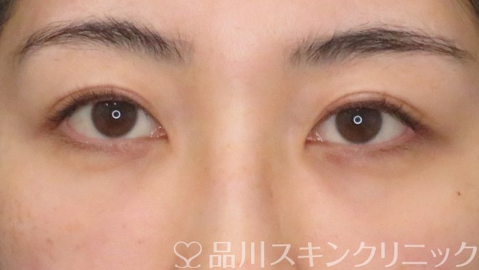 症例NO.64358のAFTER写真