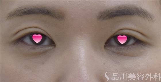 症例NO.52152のAFTER写真