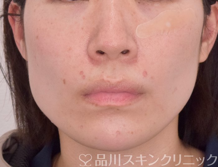 症例NO.63989のBEFORE写真