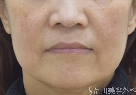 症例NO.47548のBEFORE写真
