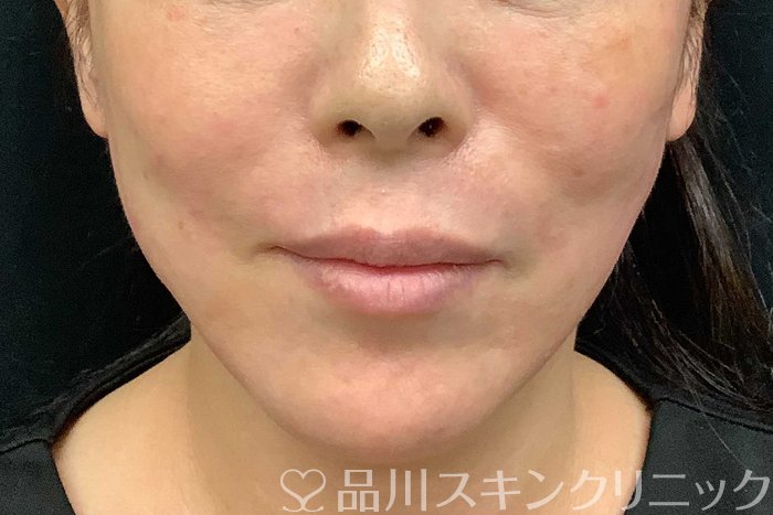 症例NO.69706のAFTER写真
